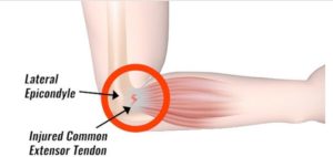 tennis elbow exercises